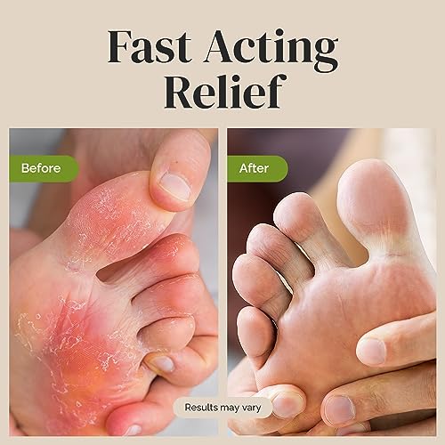 Puriya Tea Tree Oil Antifungal Cream, Plant-Powered Athletes Foot Cream Treatment Puriya