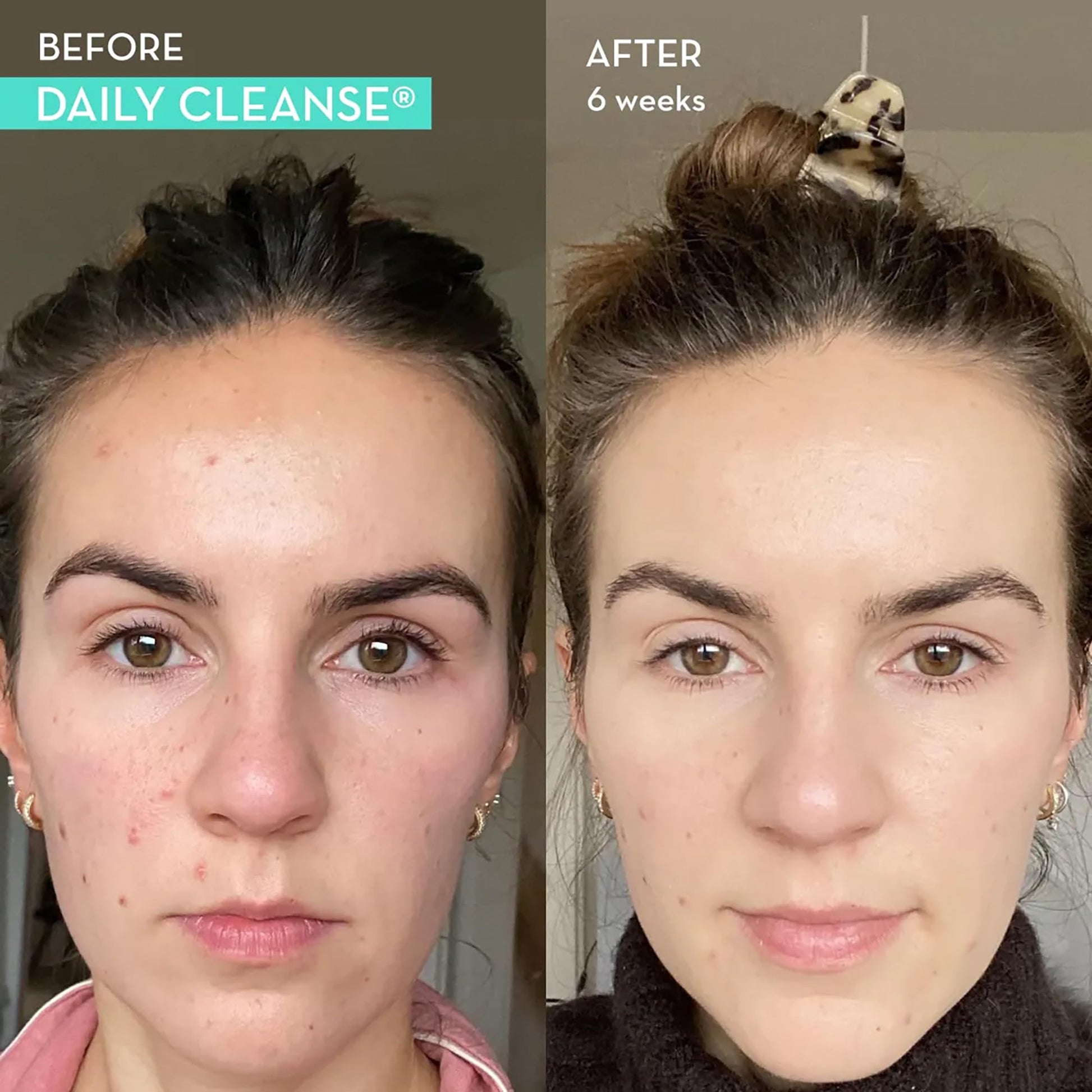HUM Daily Cleanse Acne Supplements - Support for Clear Skin & Improved Digestion HUMBuy Supplements Australia